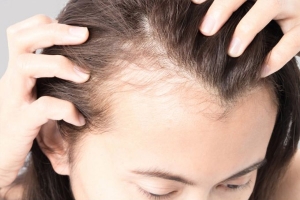 Calvície Feminina (Alopecia Androgenética)